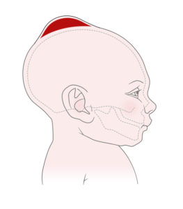 Newborn Cephalohematoma - Causes, Symptoms & Treatment